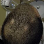 Genetics are Responsible for the Autoimmune Disease known as Alopecia