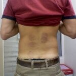 Free Lower Back Pain Screening for Patients